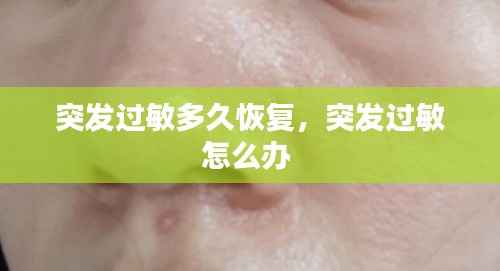 突发过敏多久恢复,突发过敏怎么办